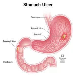 Foods to avoid if you are battling with ulcer