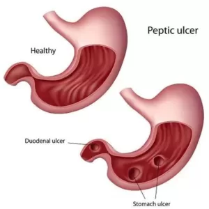 Symptoms and causes of stomach ulcer